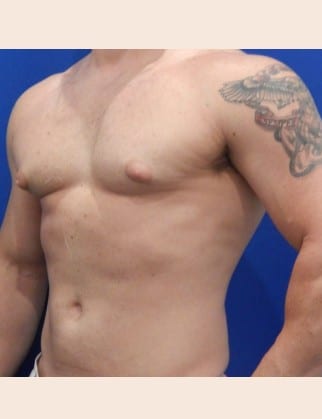 Before Image: Male Breast Reduction - front