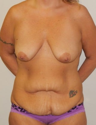 Before Image: Mommy Makeover - front