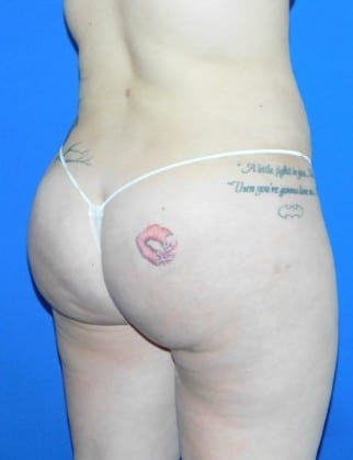 After Image: Brazilian Buttock Lift - other