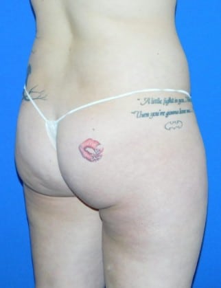 Before Image: Brazilian Buttock Lift - other
