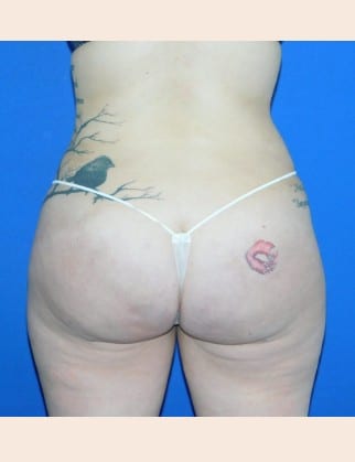 After Image: Brazilian Buttock Lift - back