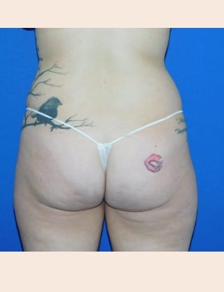 Before Image: Brazilian Buttock Lift - back