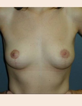 After Image: Breast Asymmetry - front