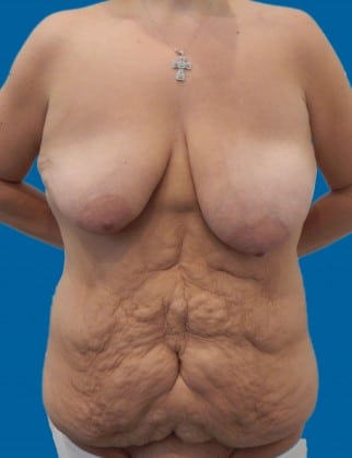 Before Image: Post-Bariatric Body Contouring - front