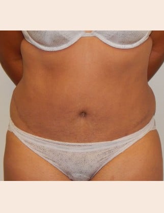 After Image: Abdominoplasty - front