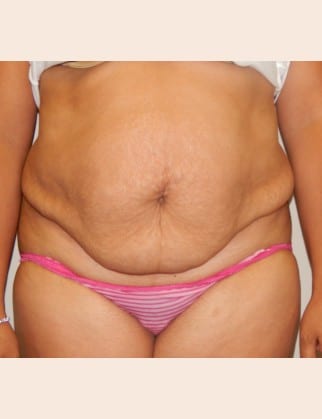 Before Image: Abdominoplasty - front