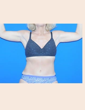 After Image: Brachioplasty - front