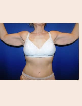 Before Image: Brachioplasty - front