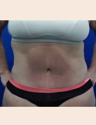 After Image: Post-Bariatric Body Contouring - front