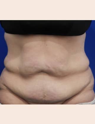 Before Image: Post-Bariatric Body Contouring - front