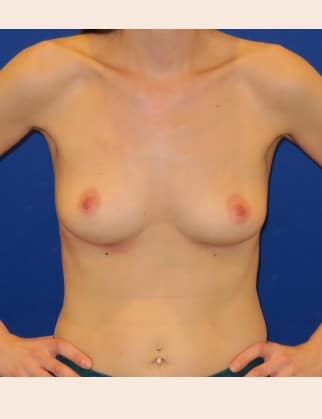 After Image: Breast Implant Removal - front