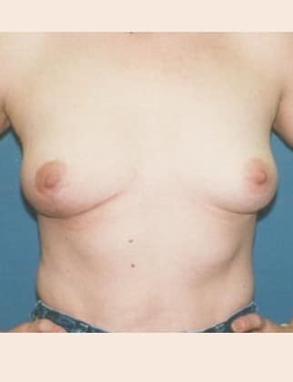 After Image: Breast Asymmetry - front
