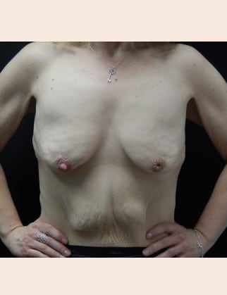 Before Image: Breast Augmentation with Lift - front