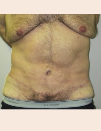 After Image: Male Abdominoplasty - front