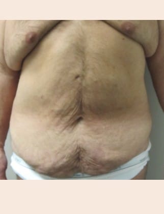 Before Image: Male Abdominoplasty - front