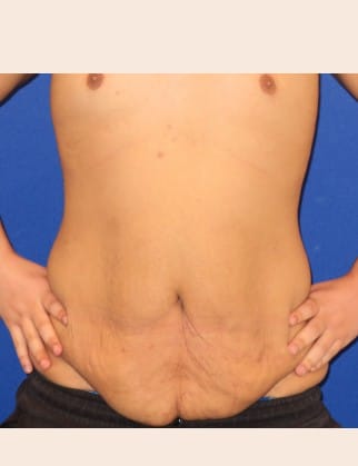 Before Image: Male Abdominoplasty - front