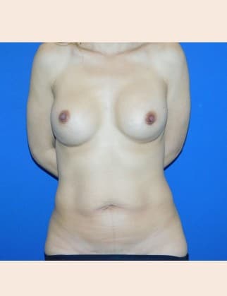 Before Image: Mommy Makeover - front
