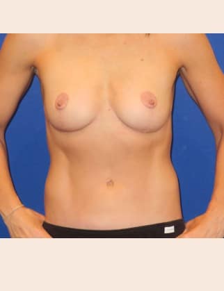 After Image: Mommy Makeover - front