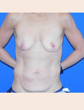 Before Image: Mommy Makeover - front