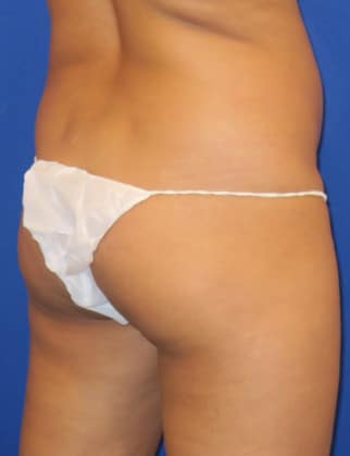 Before Image: Brazilian Buttock Lift - front