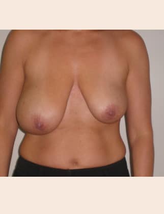 Before Image: Breast Asymmetry - front
