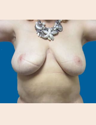 After Image: Post-Bariatric Body Contouring - front
