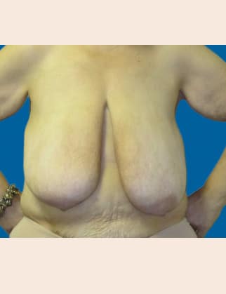 Before Image: Post-Bariatric Body Contouring - front