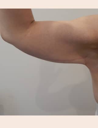 After Image: Brachioplasty - front