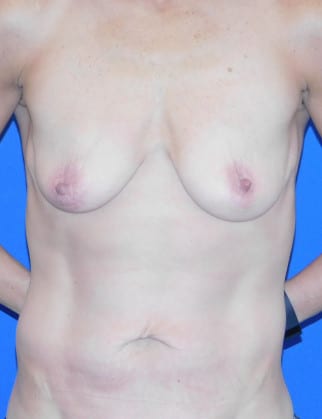Before Image: Breast Augmentation with Lift - front