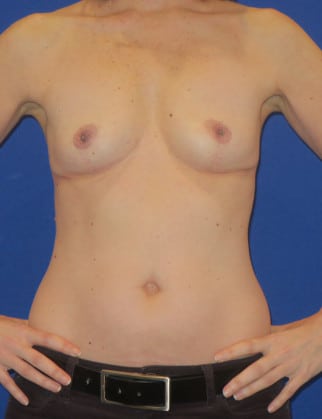 After Image: Breast Implant Removal - front