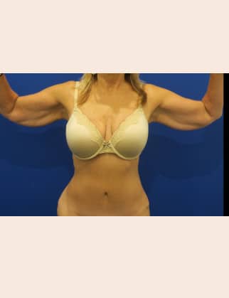 Before Image: Brachioplasty - front