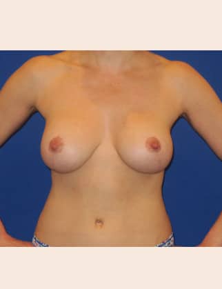 After Image: Breast Augmentation with Lift - front