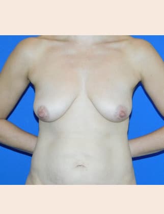 Before Image: Breast Augmentation with Lift - front