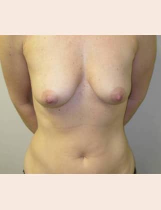 Before Image: Breast Augmentation - front