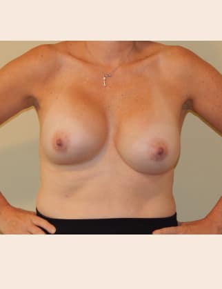 Before Image: Breast Implant Revision - front