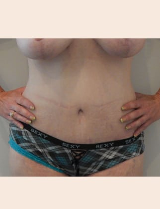 After Image: Abdominoplasty - front