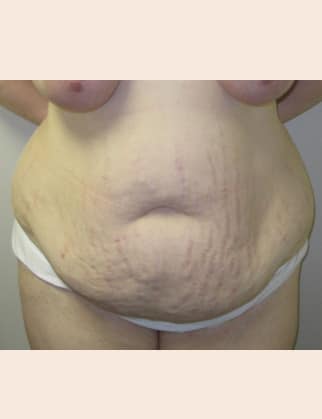 Before Image: Abdominoplasty - front