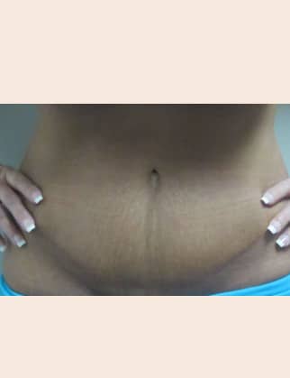 After Image: Abdominoplasty - front