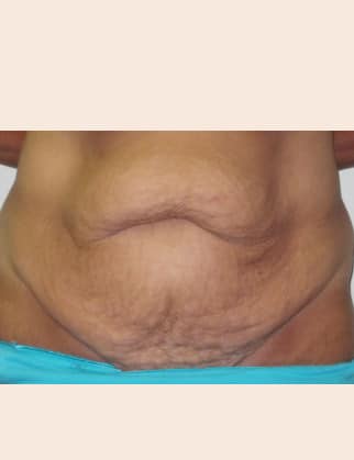 Before Image: Abdominoplasty - front
