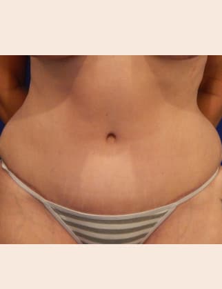 After Image: Abdominoplasty - front