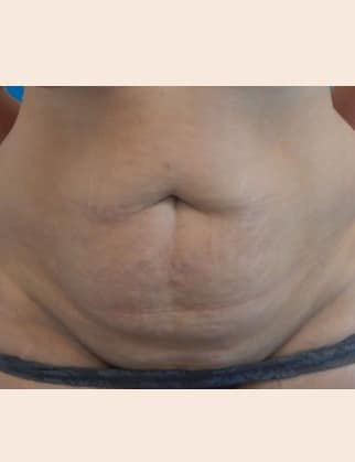 Before Image: Abdominoplasty - front