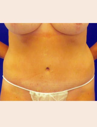 After Image: Abdominoplasty - front