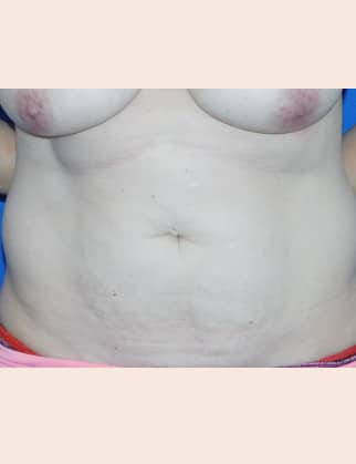 Before Image: Abdominoplasty - front