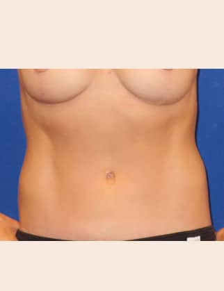 After Image: Abdominoplasty - front
