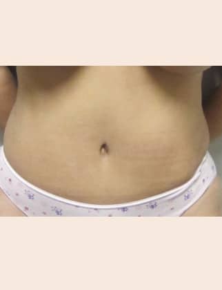 After Image: Abdominoplasty - front