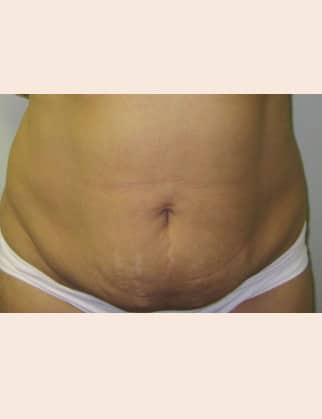 Before Image: Abdominoplasty - front