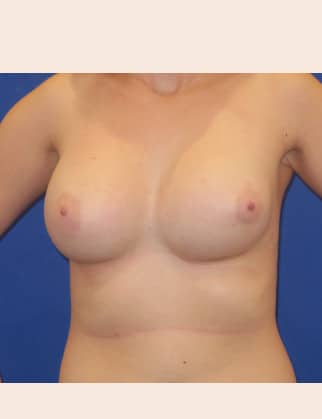 Before Image: Breast Implant Revision - front