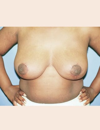 After Image: Breast Reduction - front