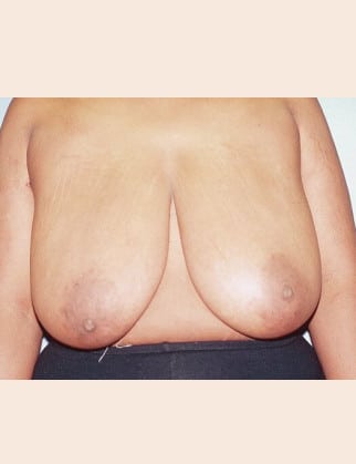 Before Image: Breast Reduction - front