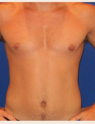 After Image: Male Breast Reduction - front